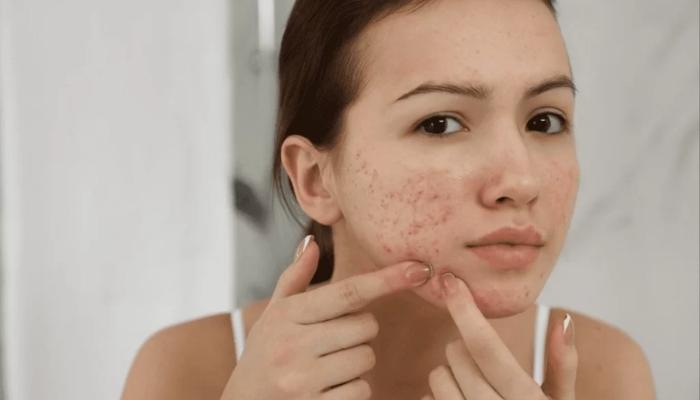 Những thói quen xấu nên bỏ khi chăm sóc da sau nặn mụn