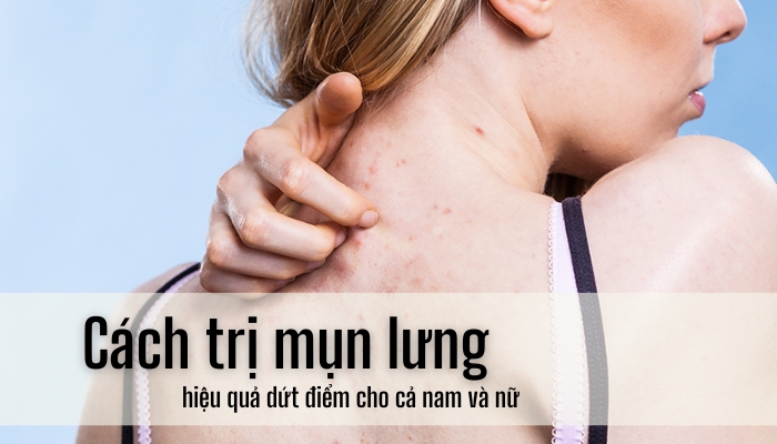 Cách trị mụn lưng hiệu quả dứt điểm cho cả nam và nữ